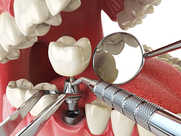 Best Emergency Treatment for Dental Infections or Abscesses in Higganum, CT